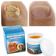 Sumifun - Nail Fungus Ointment (Original)